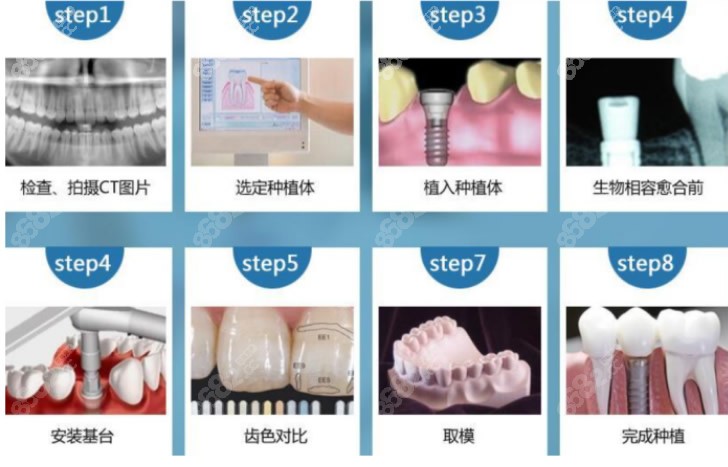 种植牙过程和步骤