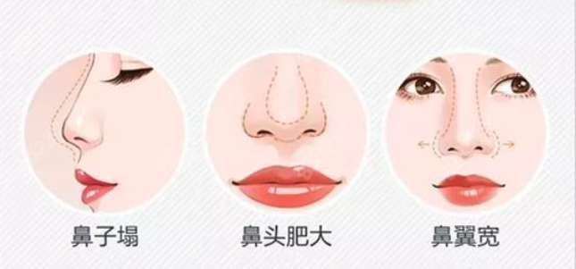 王英勇做鼻子划算