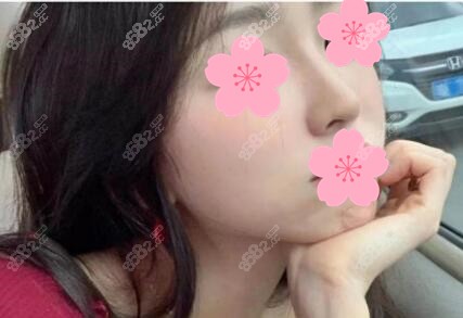 王英勇鼻修复术后照片