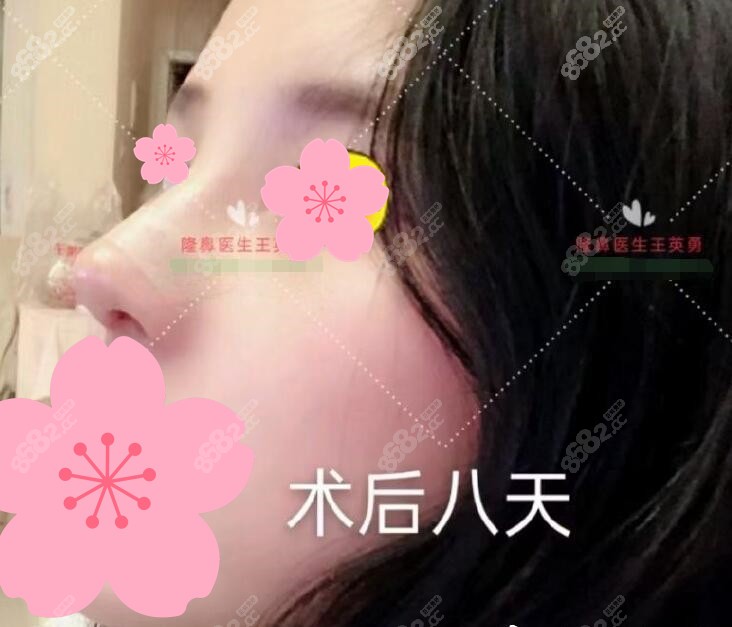 王英勇鼻修复术后照片