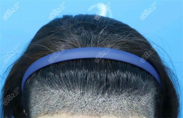 廣州倍生植發(fā)實(shí)例