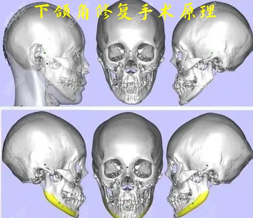 <!--<i data=20240705-sp></i>-->医生做下颌角修复手术原理图