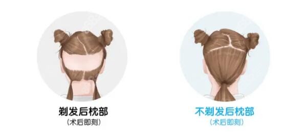 NAHT藝術(shù)植發(fā)技術(shù)的優(yōu)勢特點在于可以不剃發(fā)