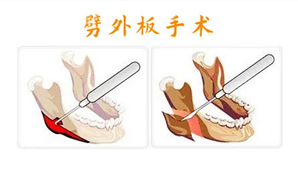 <!--<i data=20240705-sp></i>-->医生做劈外板手术的原理图