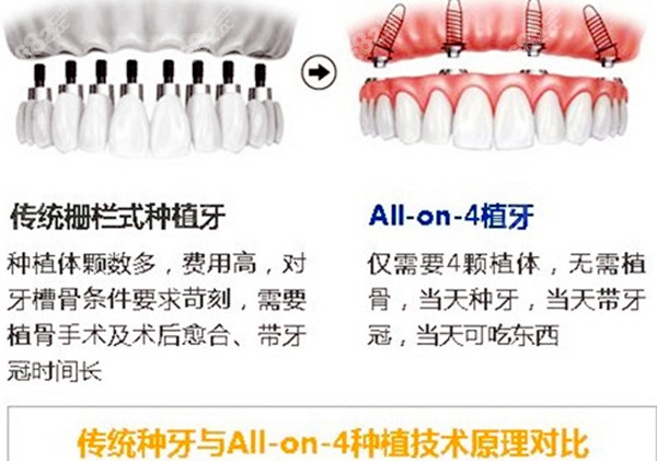 传统种牙和all on 4种牙技术原理对比