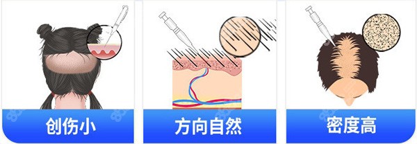 SEP2.0植發(fā)技術(shù)的優(yōu)勢特點在于適合加密不傷原生發(fā)