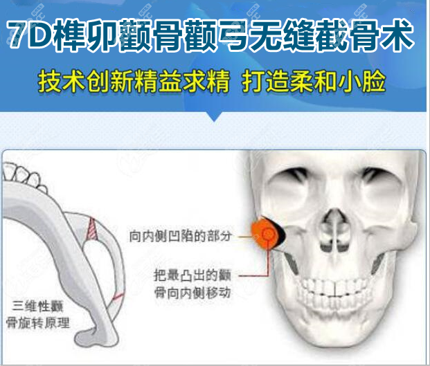 广州紫馨7D榫卯颧骨颧弓无缝截骨术