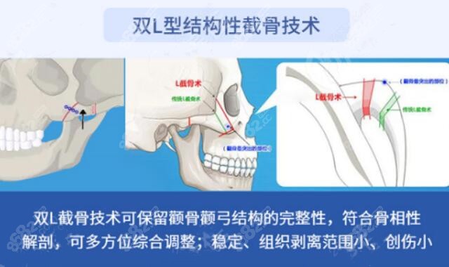 双L结构截骨技术