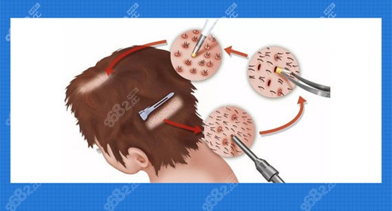 倍生FUE無痕高精密植發(fā)技術(shù)