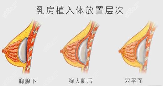 唐山苏亚美联臣医疗美容医院隆胸优势2