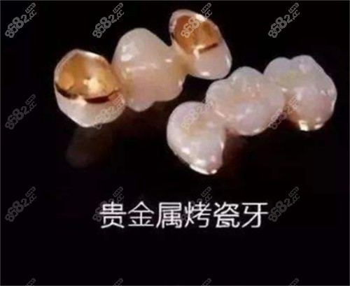 貴金屬烤瓷牙 貴金屬烤瓷牙