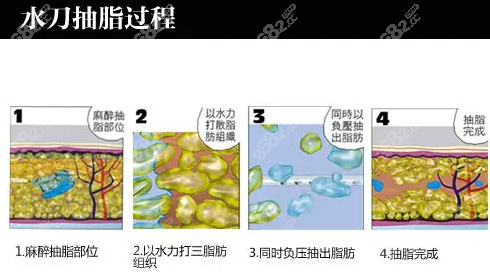 水动力抽脂过程