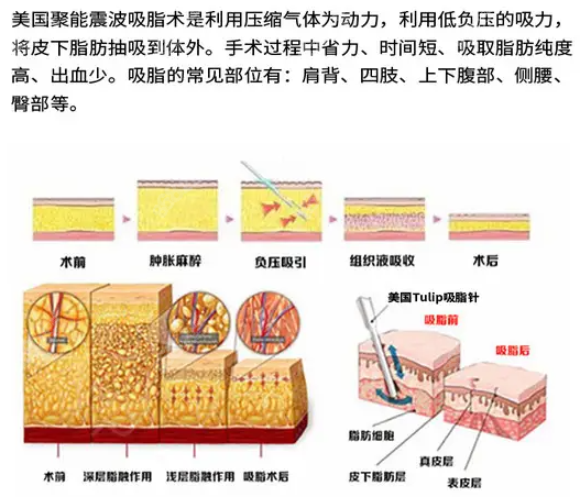 负压吸脂的优势
