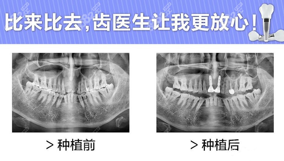 齿医生口腔做种植牙较好