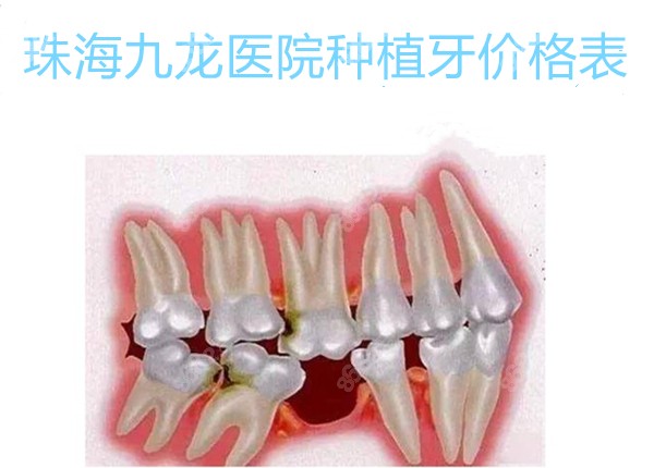 珠海九龙医院种植牙价格表