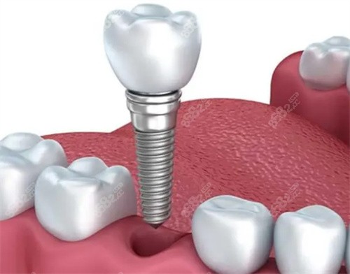 长沙中诺口腔种植牙
