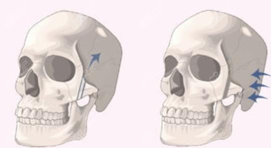 上海薇琳<!--<i data=20240705-sp></i>-->颧骨内推示意图