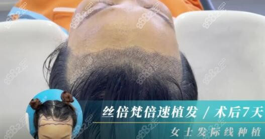 西安沐森植发女士发际线种植7天对比照