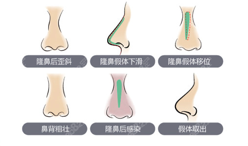 北京巫文云鼻修复做的好