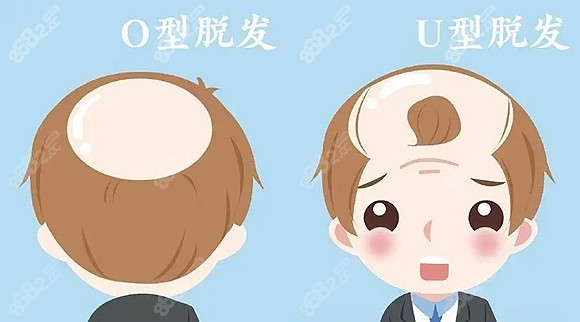 植发3000个毛囊的价格