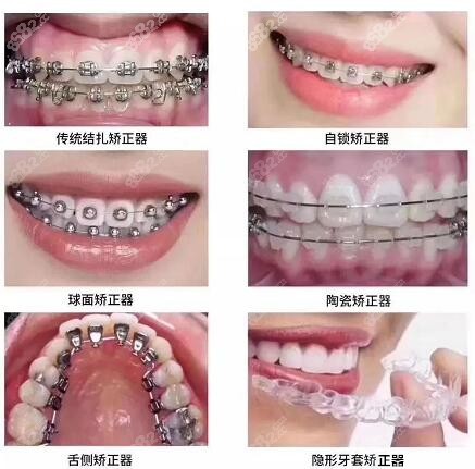 深圳市人民医院牙科牙齿矫正价格