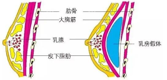 隆胸