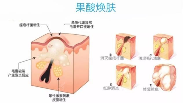 上海薇琳做果酸换肤挺好的