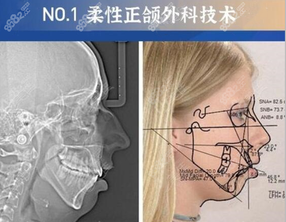 重庆宽仁柔性地包天正颌外科技术