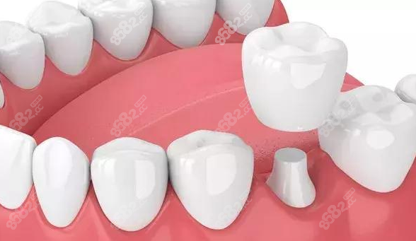 種植后的牙齒 種植后的牙齒