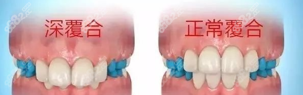 牙齿深覆合矫正难度大吗