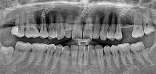芜湖美臣口腔种牙CT术前