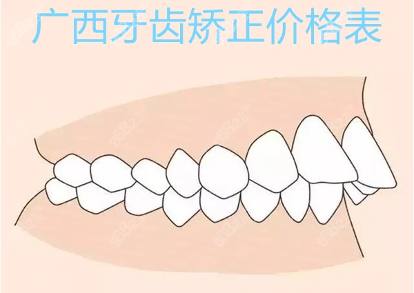 广西牙齿矫正价格表