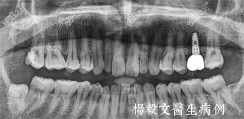 芜湖美臣口腔种植牙CT