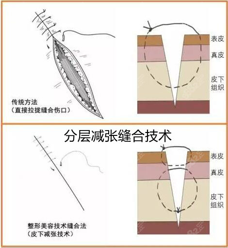 减张缝合拆线方法图解图片