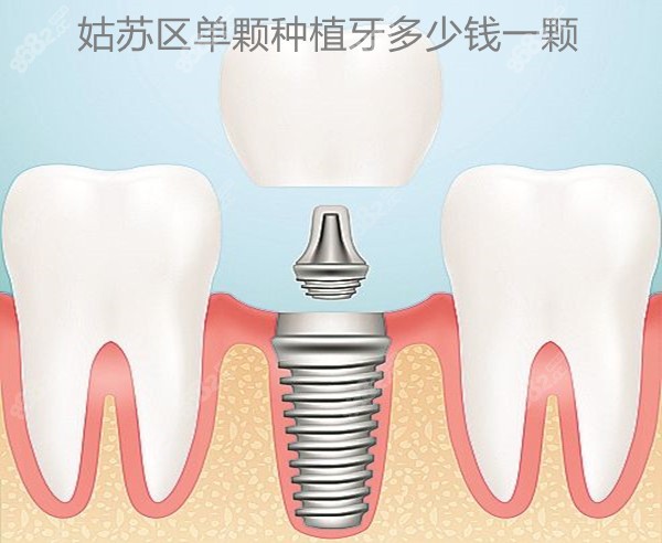 苏州姑苏区种植牙一颗多少钱