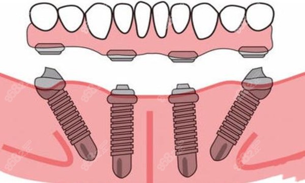成都allon4半口即刻种植牙的费用