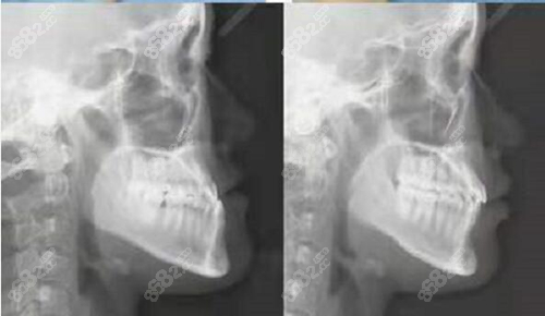 于洪波正颌手术前后对比图
