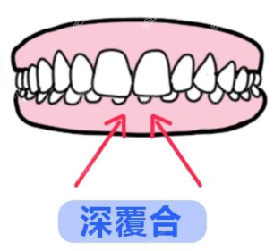 牙齿深覆合矫正难度大吗