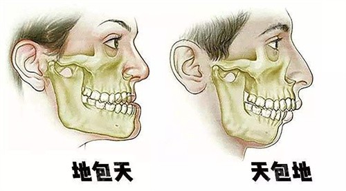 正颌手术需要多少钱？