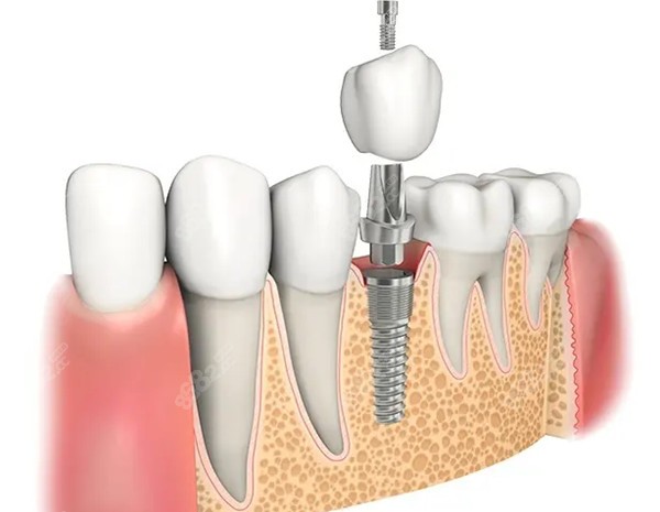青岛牙博士口腔医院价目表更新含种植牙牙齿矫正等费用