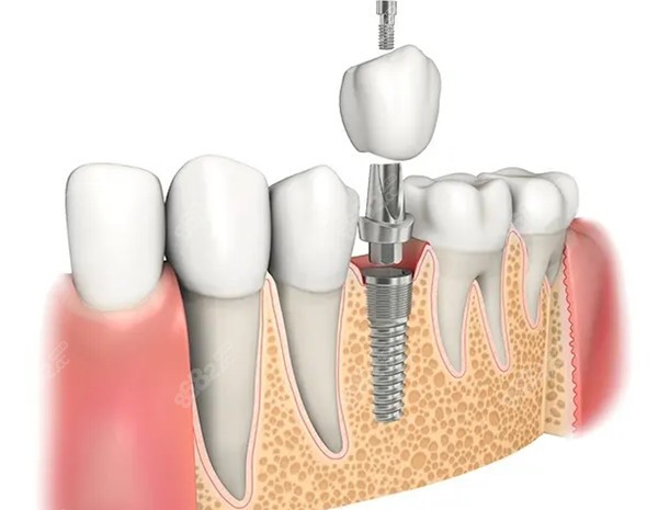 种植牙过程
