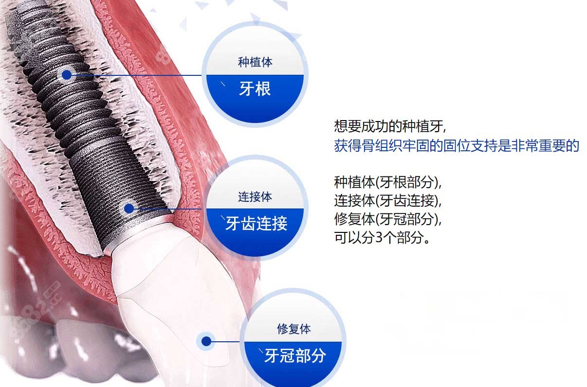 穿颧种植牙手术很难吗