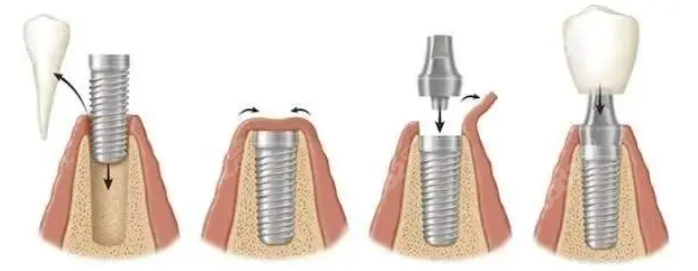 贵阳柏德口腔做种植牙手术过程
