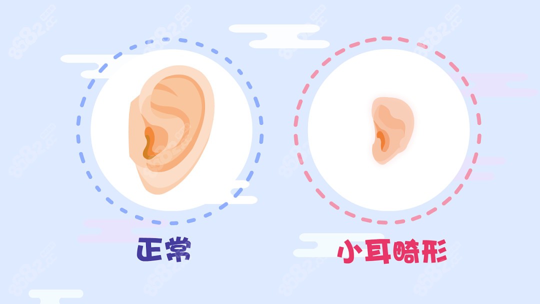张正文耳再造手术前后对比图