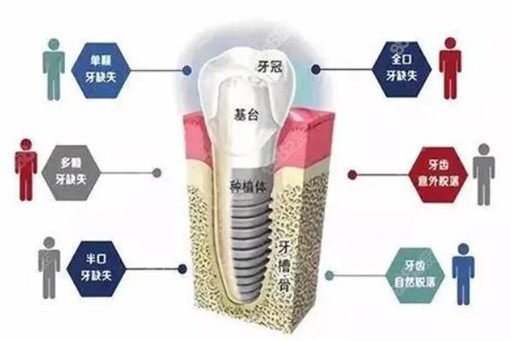 廊坊8020口腔種植牙收費(fèi)標(biāo)準(zhǔn)