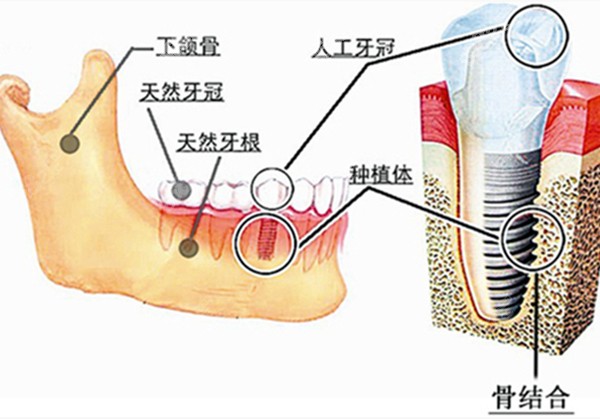 种植牙跟天然牙的对比