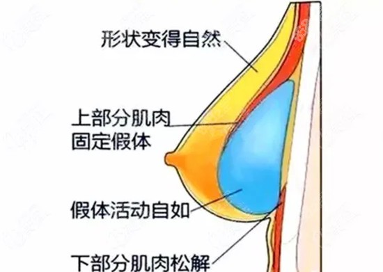 <!--<i data=20240705-sp></i>-->做假体隆胸怎么样