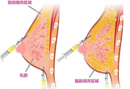 郑州华领徐刚强脂肪填充区域