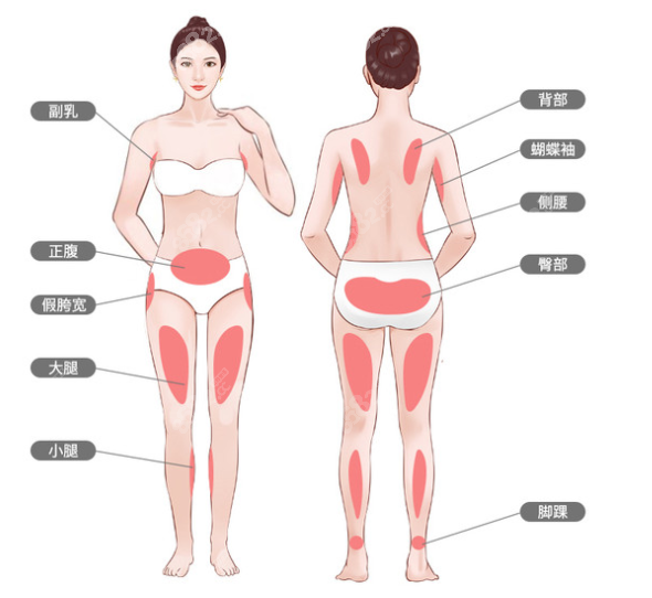 南宁东方做吸脂的部位图
