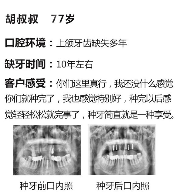 北京康贝佳口腔半口种植牙病例及顾客10年后种牙感受